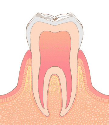 エナメル質表面がわずかに脱灰している状態