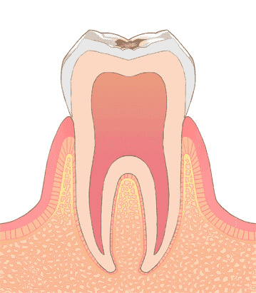 エナメル質内部に虫歯が進行した状態