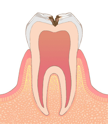 象牙質に達した状態