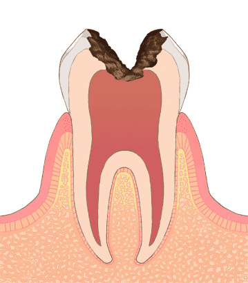 歯の神経（歯髄）まで達した状態