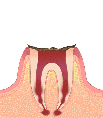 歯が崩壊し、根だけが残っている状態