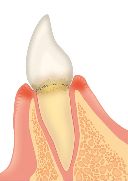 歯周炎