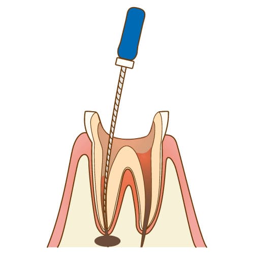 感染した歯髄の除去